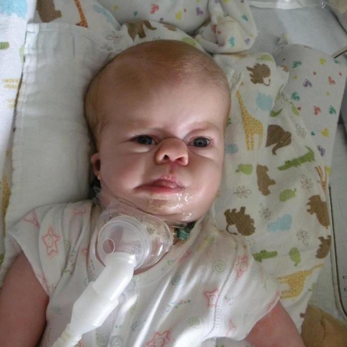 Why do families choose to keep kids who are severely deformed instead of absorption?
