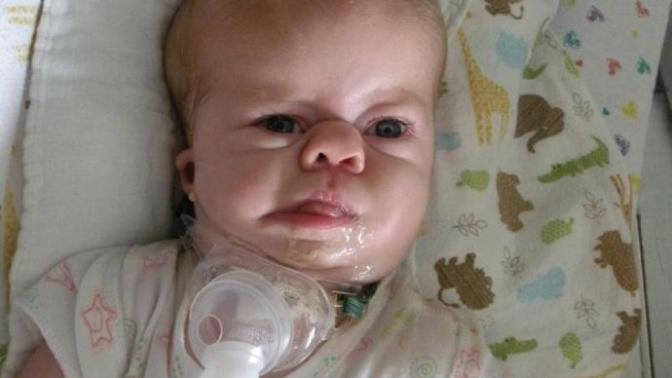Why do families choose to keep kids who are severely deformed instead of absorption?
