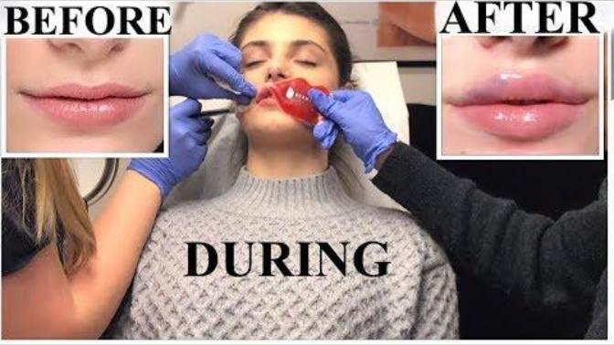 Does plastic surgery lips look better?