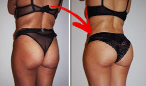 Girls, Have or would you consider cosmetic surgery?