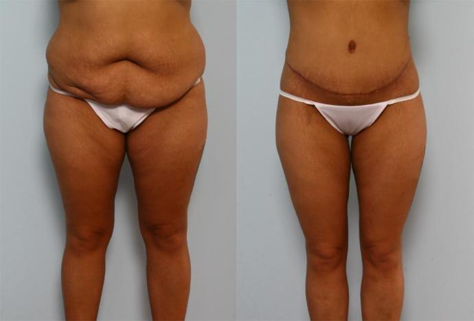 Girls, Have or would you consider cosmetic surgery?