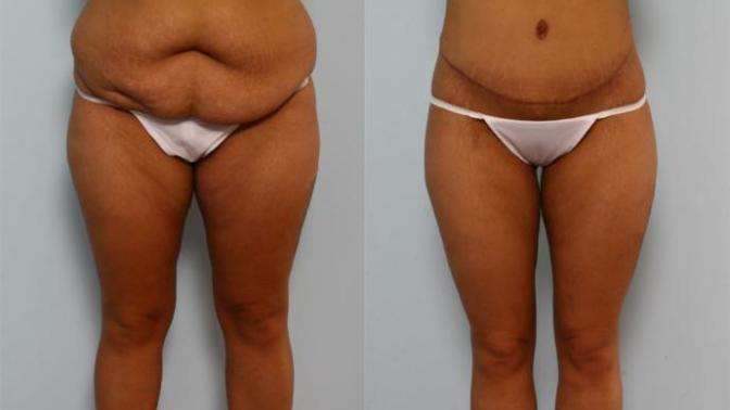Girls, Have or would you consider cosmetic surgery?