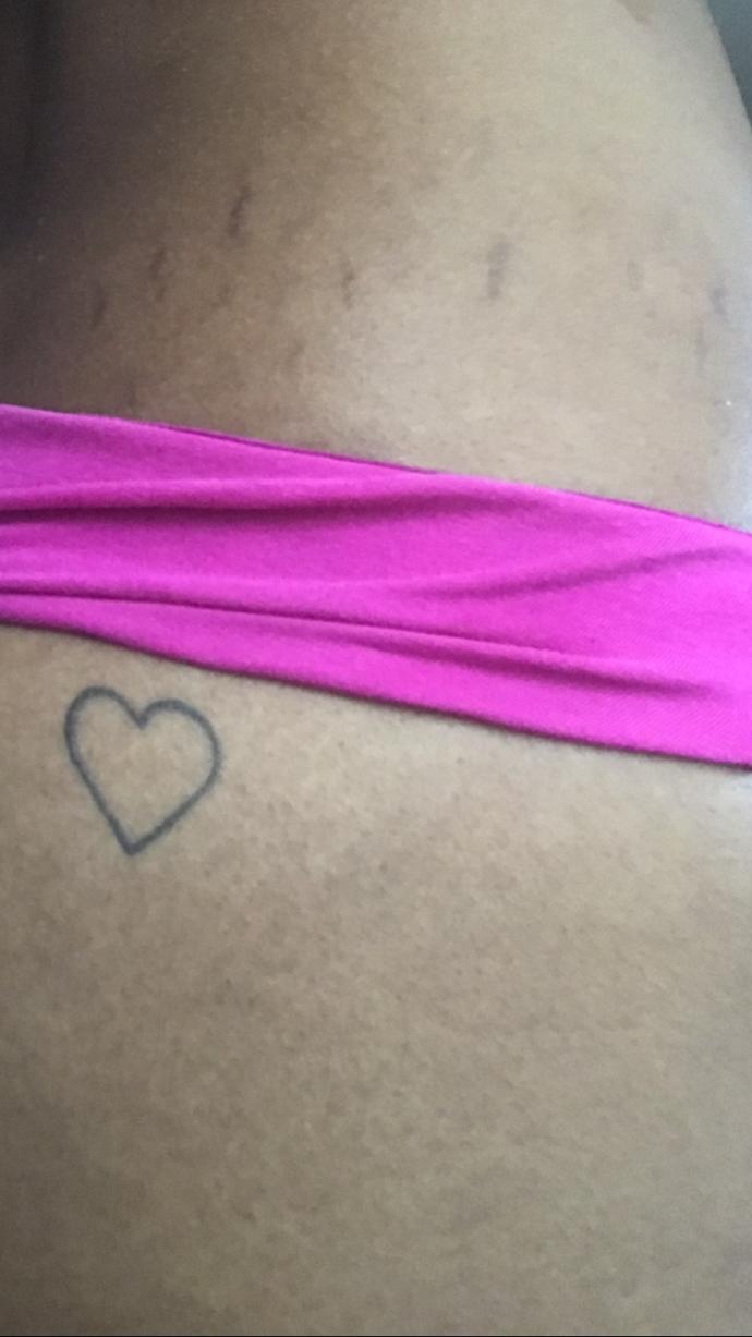 Can’t get rid of one side of stretch marks why? (other side cleared)?
