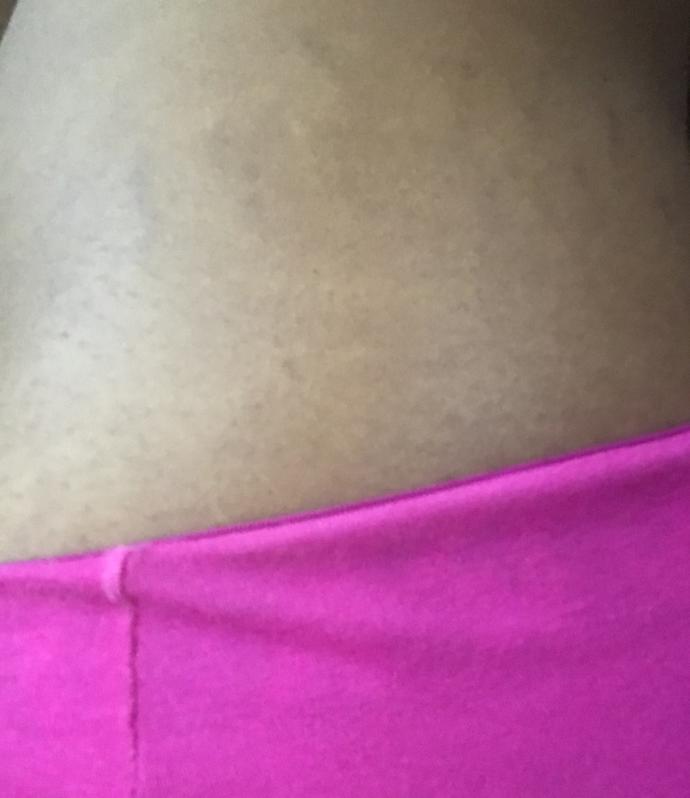 Can’t get rid of one side of stretch marks why? (other side cleared)?