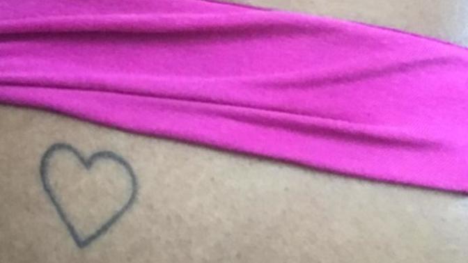 Can’t get rid of one side of stretch marks why? (other side cleared)?