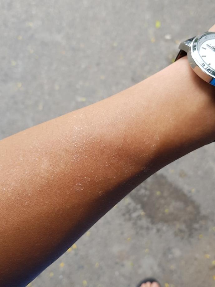 Skin problem after strong sunlight?