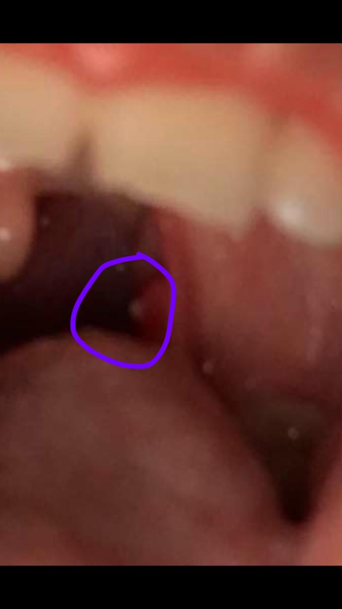 Why do I have a white pimple in my mouth help?