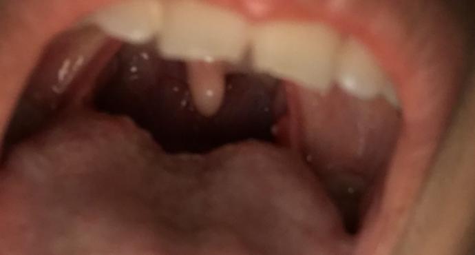 Why do I have a white pimple in my mouth help?