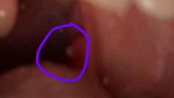 Why do I have a white pimple in my mouth help?