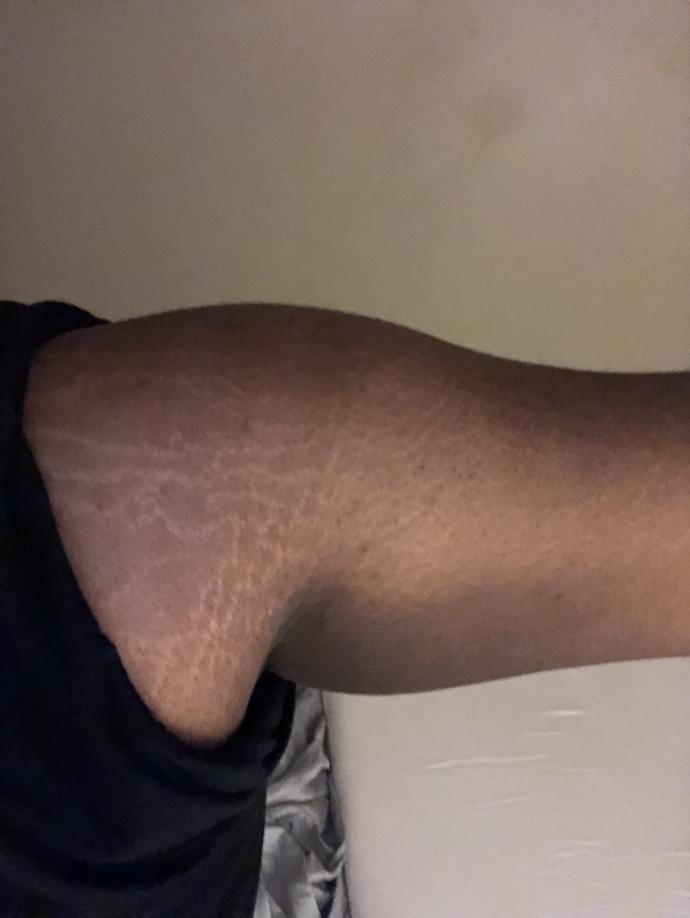 Do you have stretch marks?
