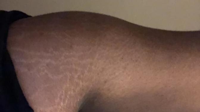 Do you have stretch marks?
