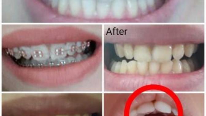 Braces problem?