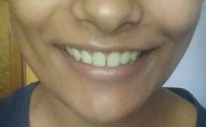 Should I get braces or veneers?