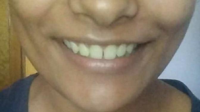 Should I get braces or veneers?
