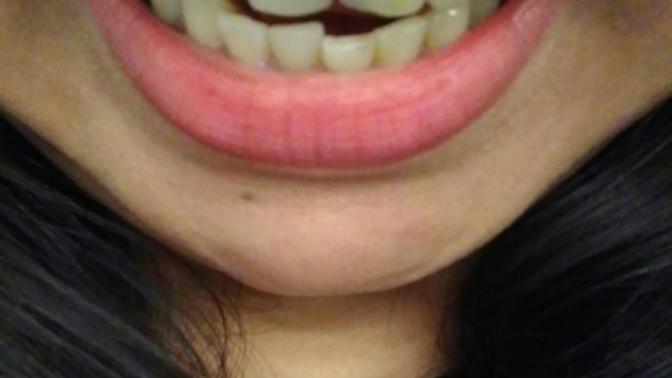 Any dentists here? I need your opinion?