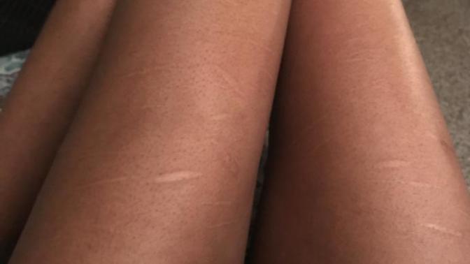 Are guys turned off by scars?