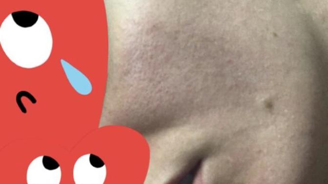 My skin looks HORRIBLE as you can see - Should I go to a doctor or am I overreacting?