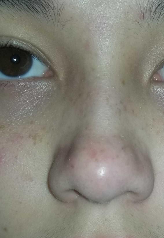 Nose red from popping blackheads?