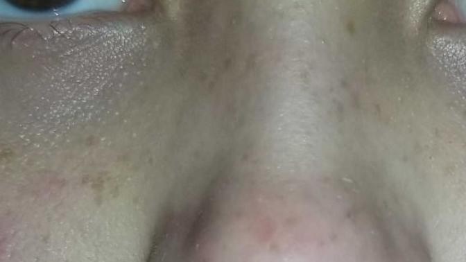 Nose red from popping blackheads?