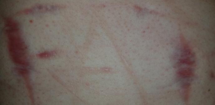 Are self harm scars on multiple areas of the body a turn off?