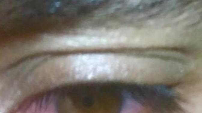 Am I becoming blind?