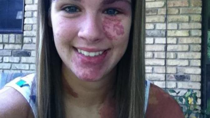 Would you date/marry a girl who had a Vitiligo skin condition? Or a Port Wine Stain condition?