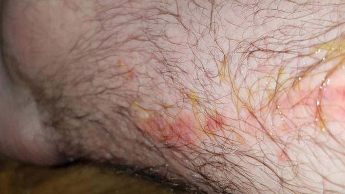 Pics are ugly... Been to two doctors for this bite/rash, given ointment, this still seems to be spreading, can anybody identify this infection?
