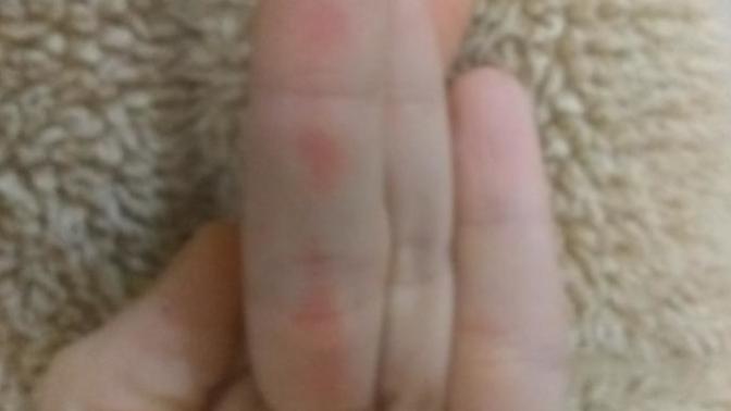 Why didn't anyone tell me about cold/frost burns?