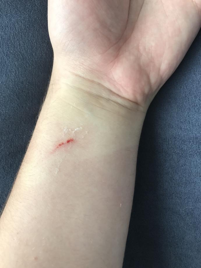 I got a dog bite on my wrist. How bad does it look?