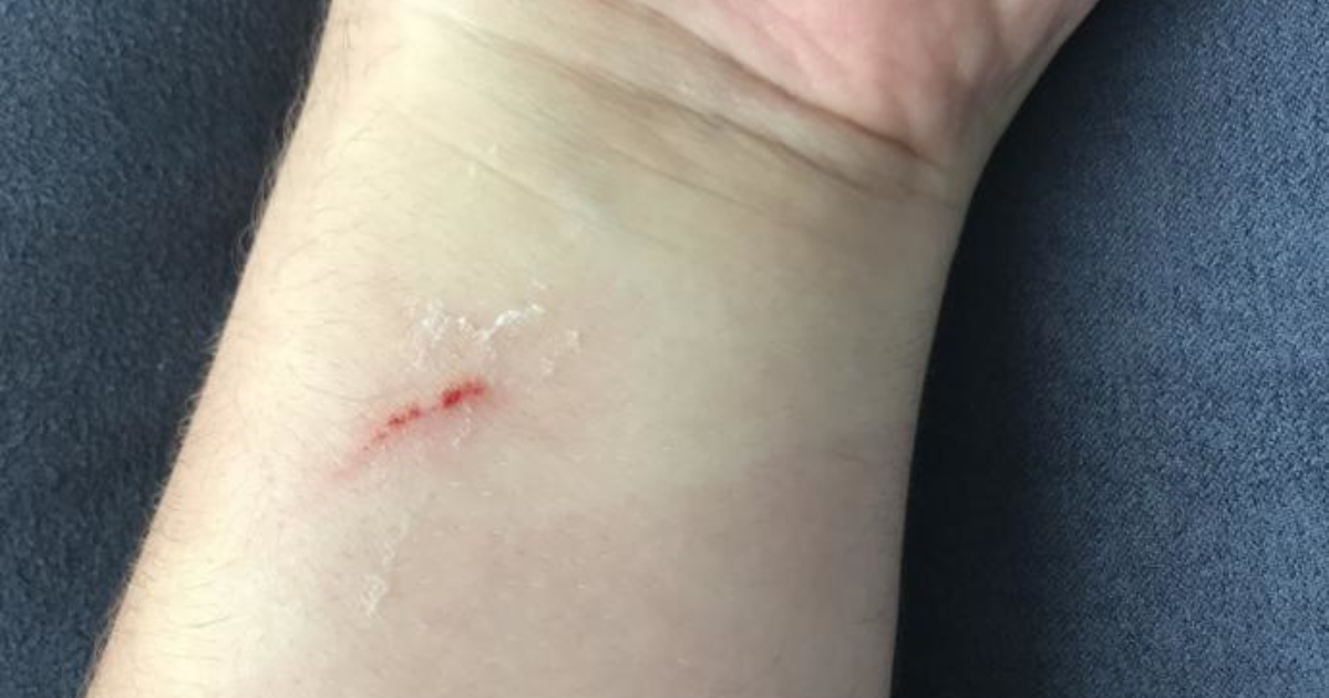 I got a dog bite on my wrist. How bad does it look? GirlsAskGuys