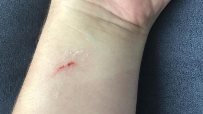 I got a dog bite on my wrist. How bad does it look?