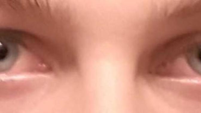My droopy eyelid is killing me, what should I do?