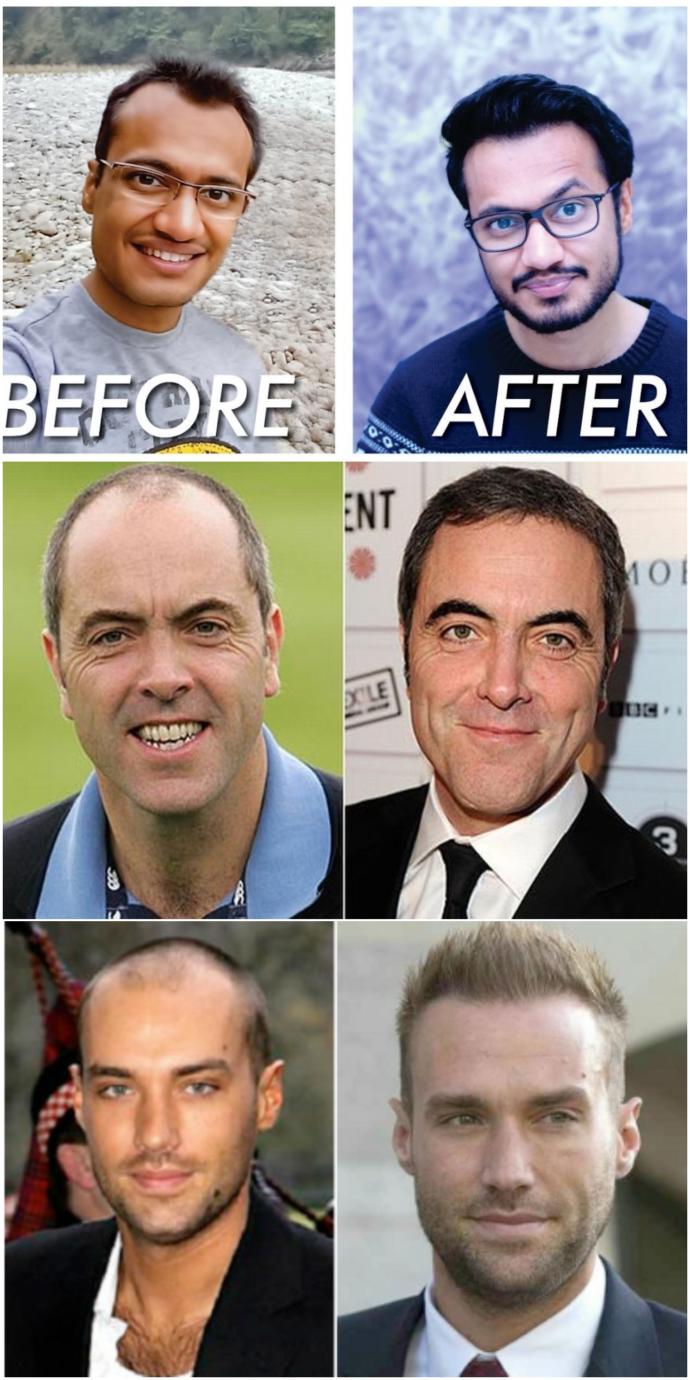 Ladies, would you be OK if your man got hair transplant surgery if he's balding?