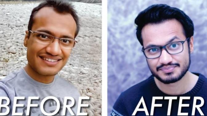 Ladies, would you be OK if your man got hair transplant surgery if he's balding?
