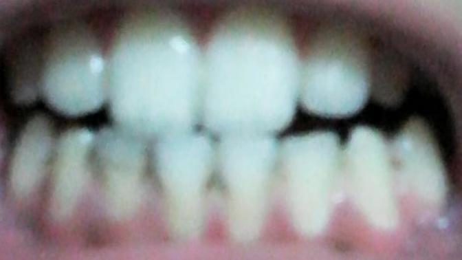 Should I file down my teeth?