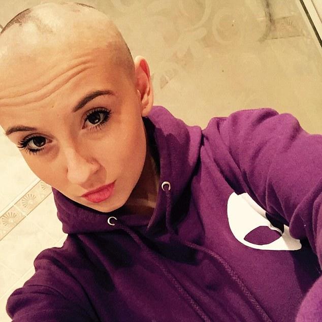 Would you date someone with Alopecia?