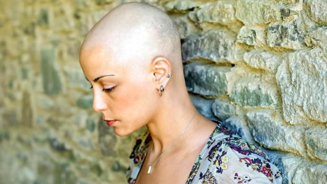 Would you date someone with Alopecia?