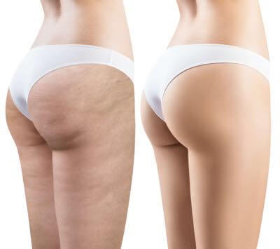 How much do guys actually care about cellulite on girls?