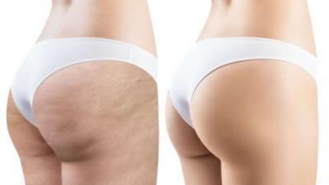 How much do guys actually care about cellulite on girls?