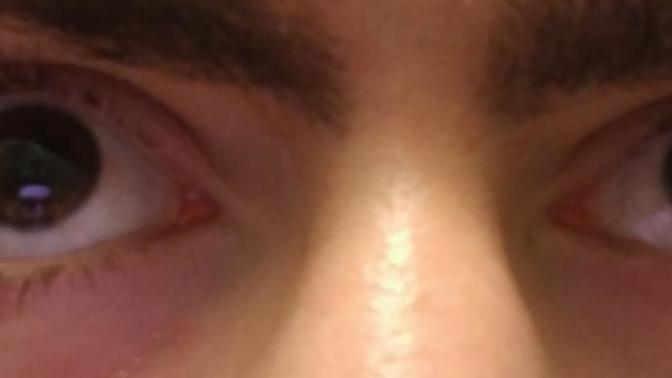 Girls, how does my gap between two eyebrows? I've puckled?
