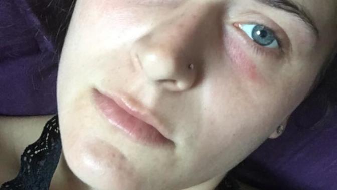 Are there any dermatologists or doctors here that know why I have these red marks under my eyes?