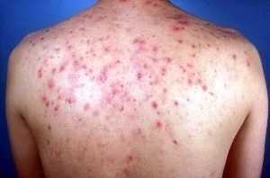 How do you get rid of acne on your back/shoulders?