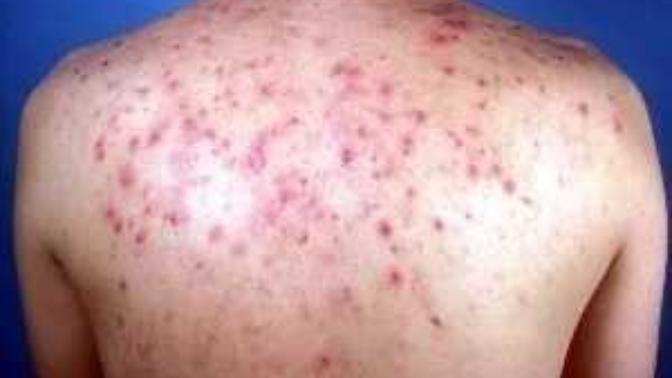 How do you get rid of acne on your back/shoulders?