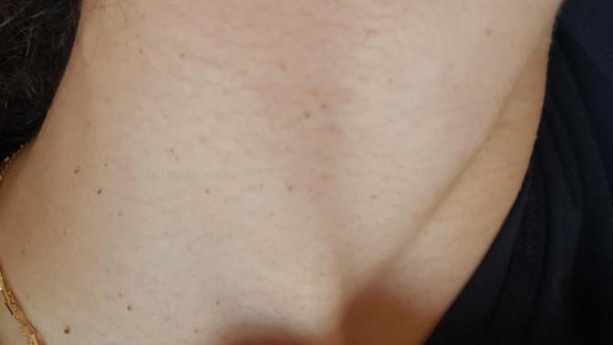 Are small skin tags unattractive on the neck?