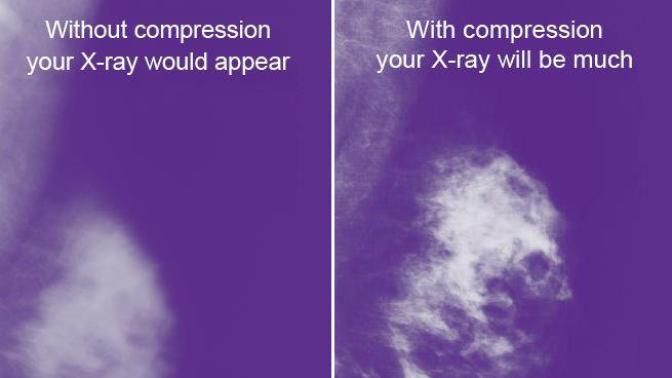 Girls, would you rather have a pleasant mammogram for a poor image (50%), uncomfortable one for a great image (93%), or a painful one for the best?
