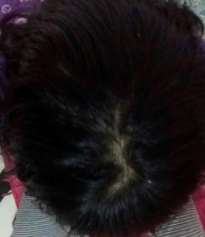Is this a bald patch?
