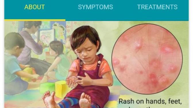My step brother has HFMD, how can I prevent getting it?