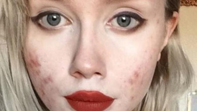 Guys do you still find girls with bad skin attractive?