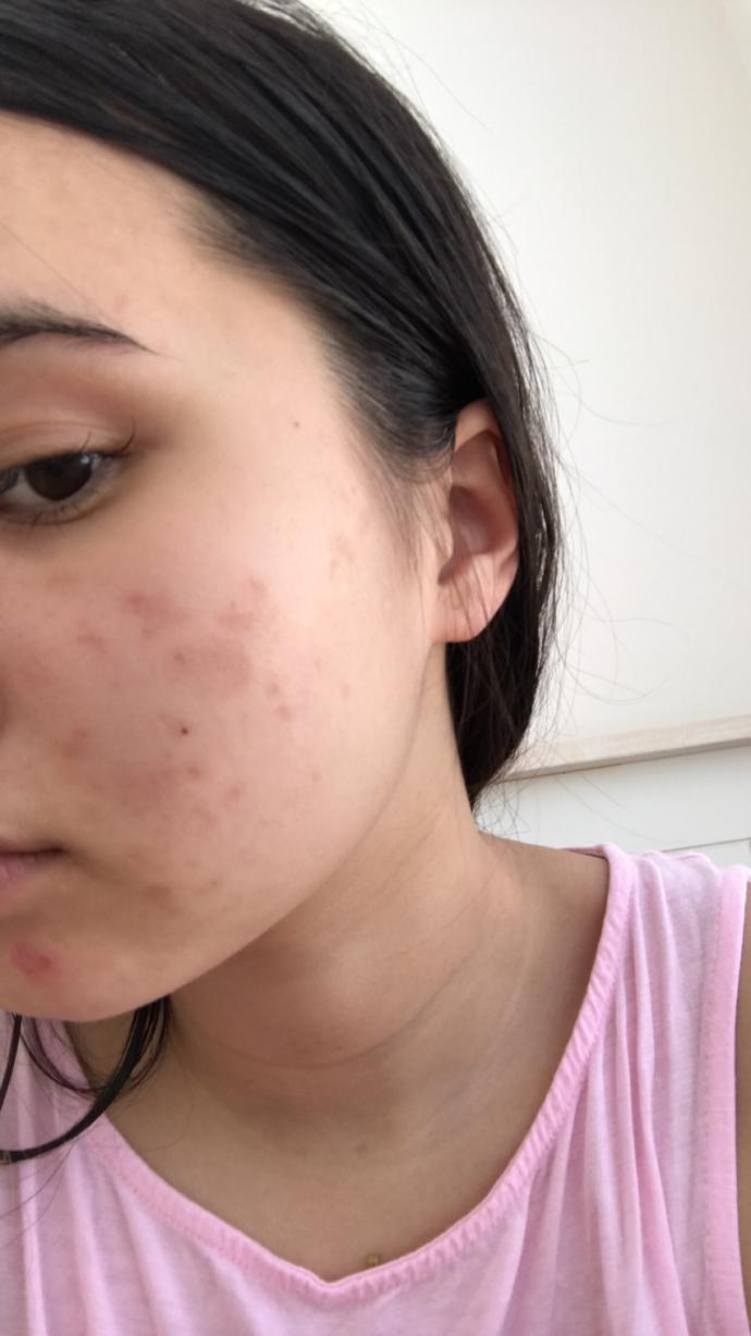 BE HONEST, Are my acne scars noticeable or bad?