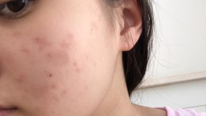 BE HONEST, Are my acne scars noticeable or bad?
